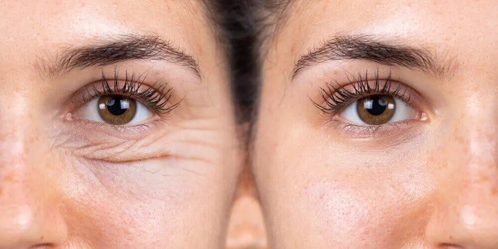 How Does Blepharoplasty Help Create a Younger Eye Appearance