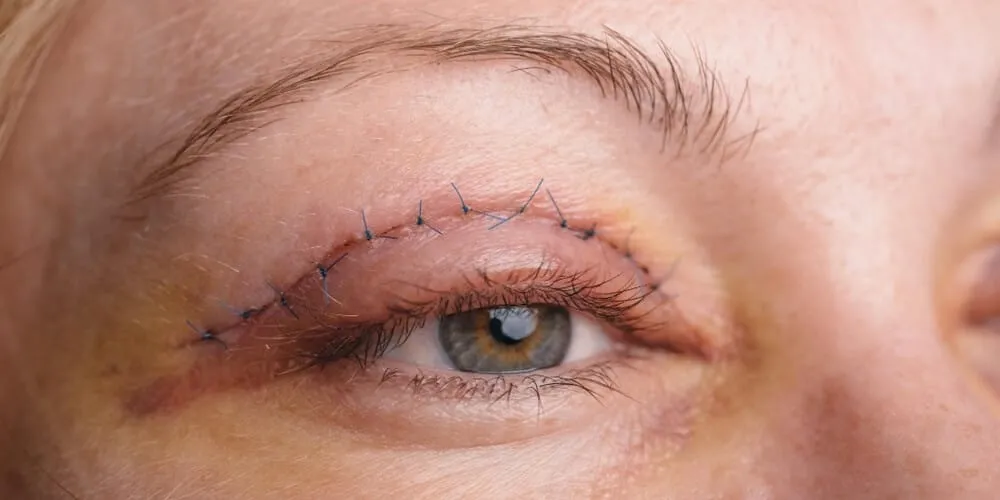 How Does Blepharoplasty Help Create a Younger Eye Appearance