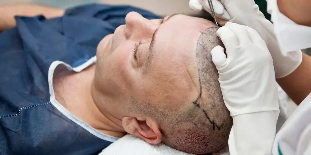 FUE Hair Transplant in Turkey