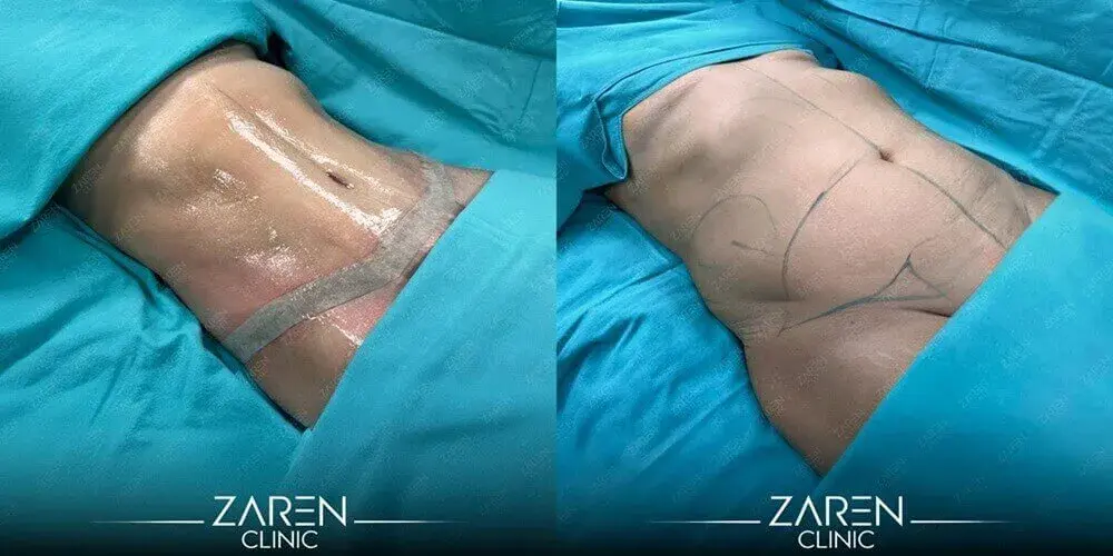 Bauchdeckenstraffung in der Türkei – Fachmännische Betreuung, echte Ergebnisse