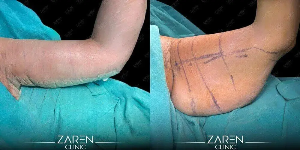 Liposucción de brazos en Turquía: Costo y resultados en 2026