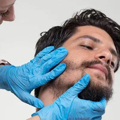 Beard And Mustache Transplant