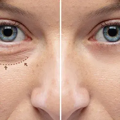 Blepharoplastik Türkei
