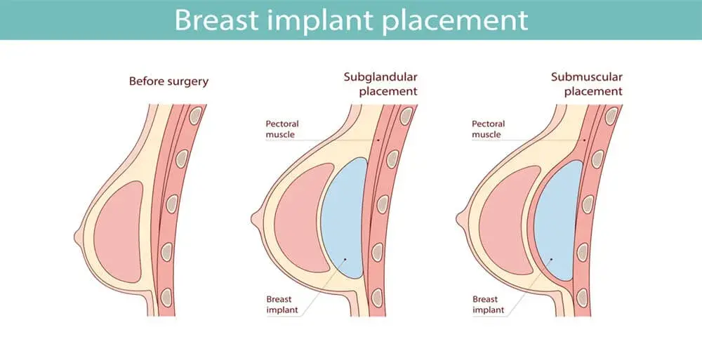 Breast Augmentation in Turkey – Safe, Beautiful, Affordable