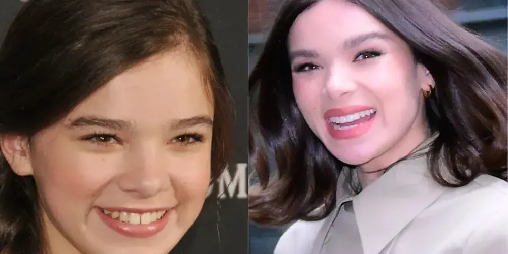 Dental Aesthetics Analysis of Hailee Steinfeld’s Hollywood Smile