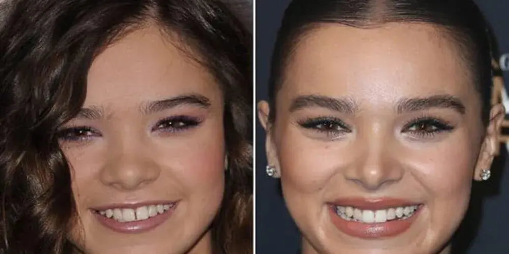 Dental Aesthetics Analysis of Hailee Steinfeld’s Hollywood Smile