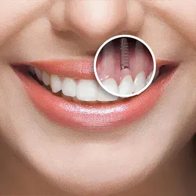 Implants dentaires en Turquie