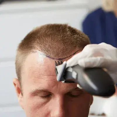 DHI Hair Transplant Turkey