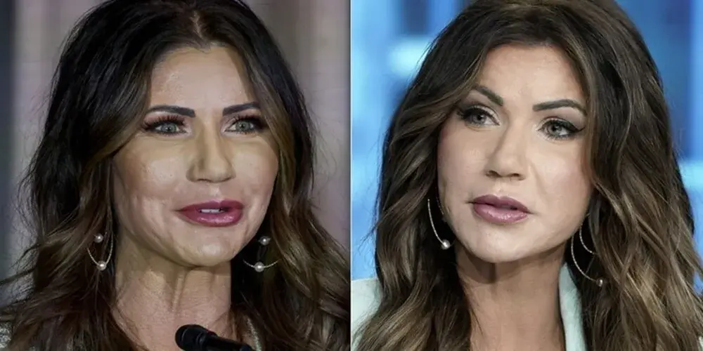 Did Kristi Noem Have Plastic Surgery? Before and After Analysis
