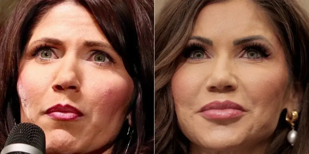 Did Kristi Noem Have Plastic Surgery? Before and After Analysis