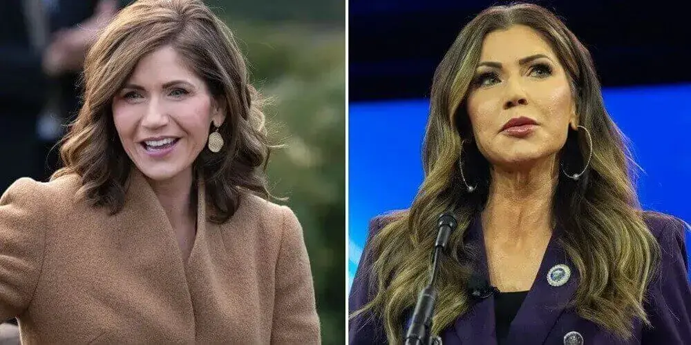 Did Kristi Noem Have Plastic Surgery? Before and After Analysis