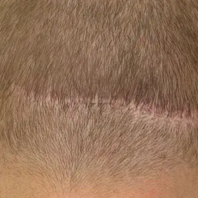 FUT Hair Transplant in Turkey