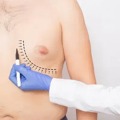 Gynäkomastie-Chirurgie Türkei