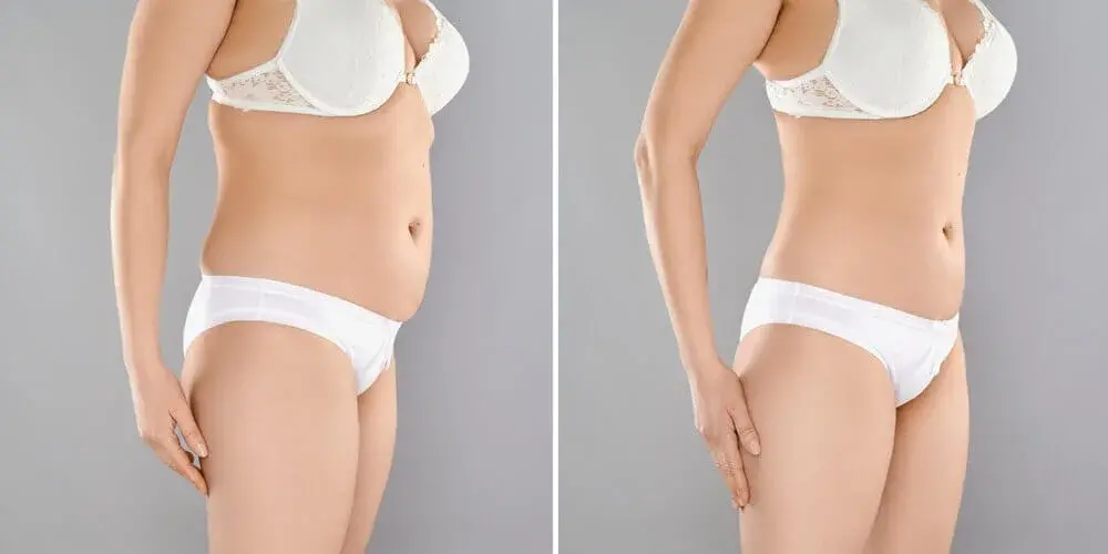 Liposuction in Turkey – 2026 Prices & Results