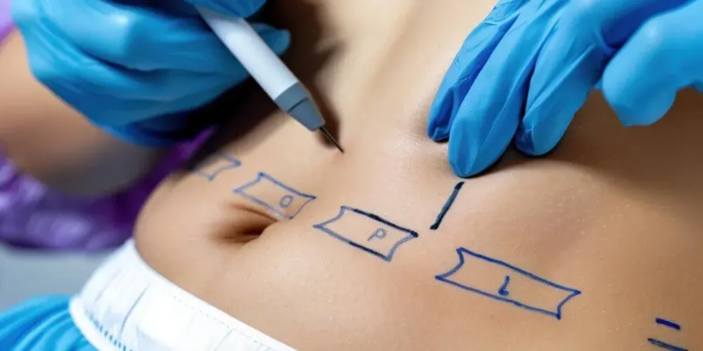 Liposuction in Turkey – 2026 Prices & Results