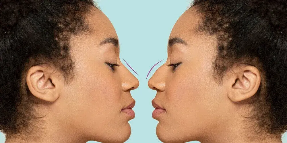 Rhinoplastik (Nasenkorrektur) in der Türkei – Kosten 2026