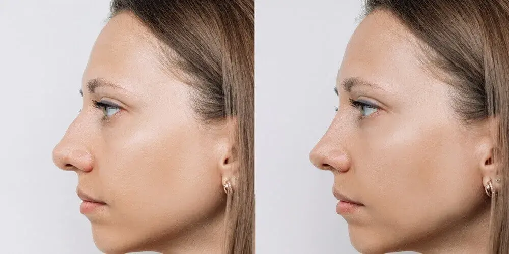Rhinoplastik (Nasenkorrektur) in der Türkei – Kosten 2026