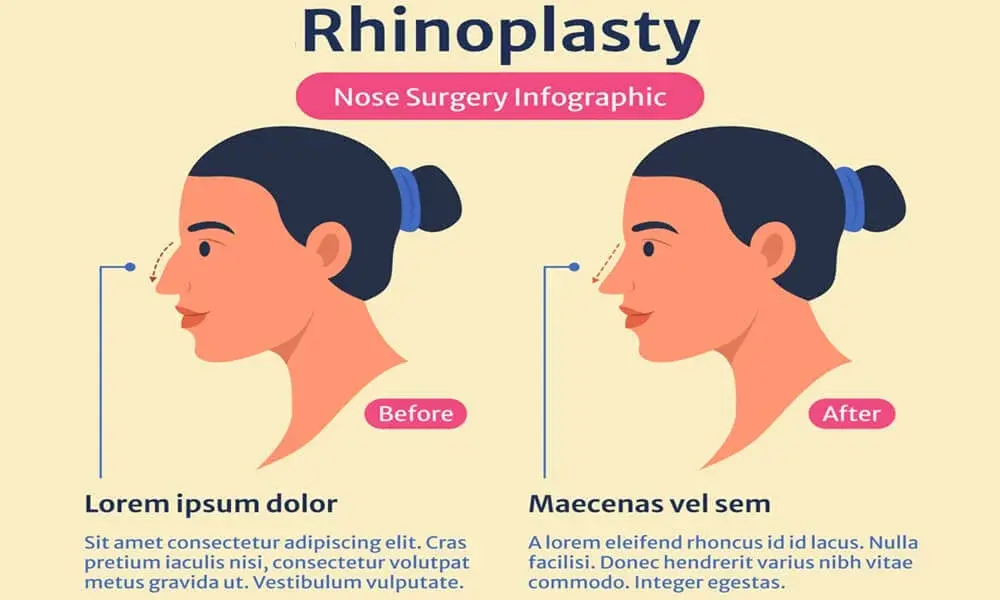 Rhinoplastik (Nasenkorrektur) in der Türkei – Kosten 2026