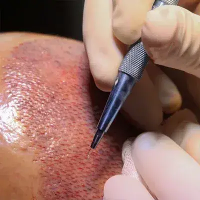 Sapphire Fue Hair Transplant Turkey
