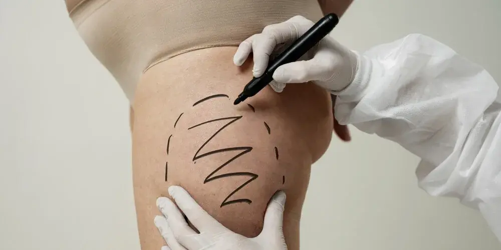 All-Inclusive Thigh Lift Packages in Turkey