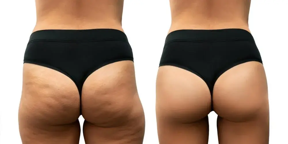 All-Inclusive Thigh Lift Packages in Turkey