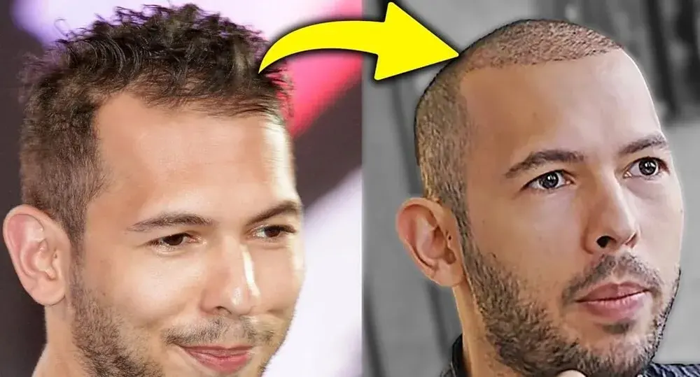 Tristan Tate Hair Transplant Amazing Change