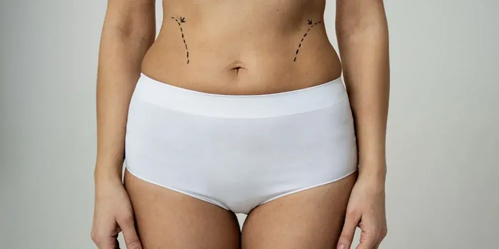 Bauchdeckenstraffung in der Türkei (Abdominoplastik)