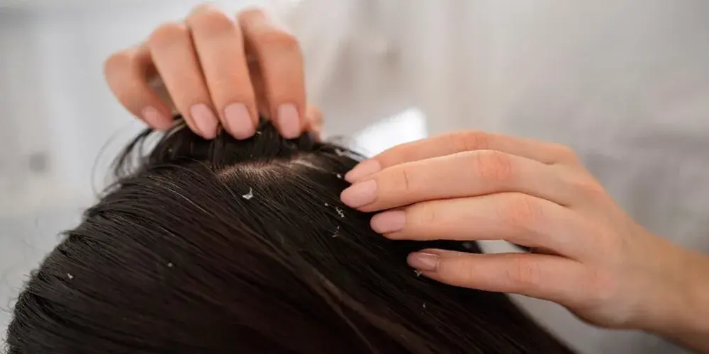 What is Scalp Eczema? Symptoms, Causes, and Treatment Options